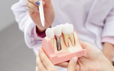 Dental Implants or Tooth Implants