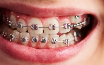 Orthodontic Treatments / Braces Treatments