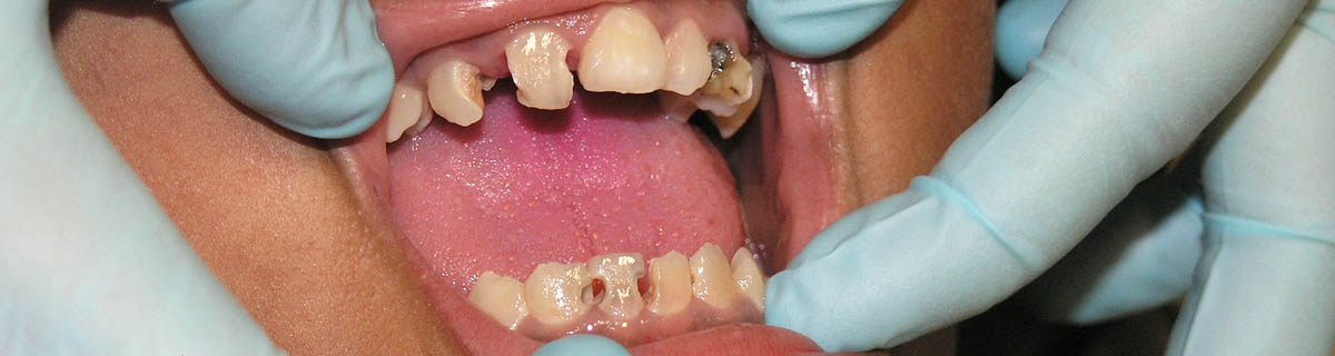 Dental Cavity