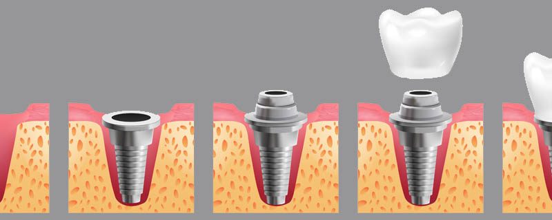 Dental Implants or Tooth Implants from best Dental Clinic Trivandrum