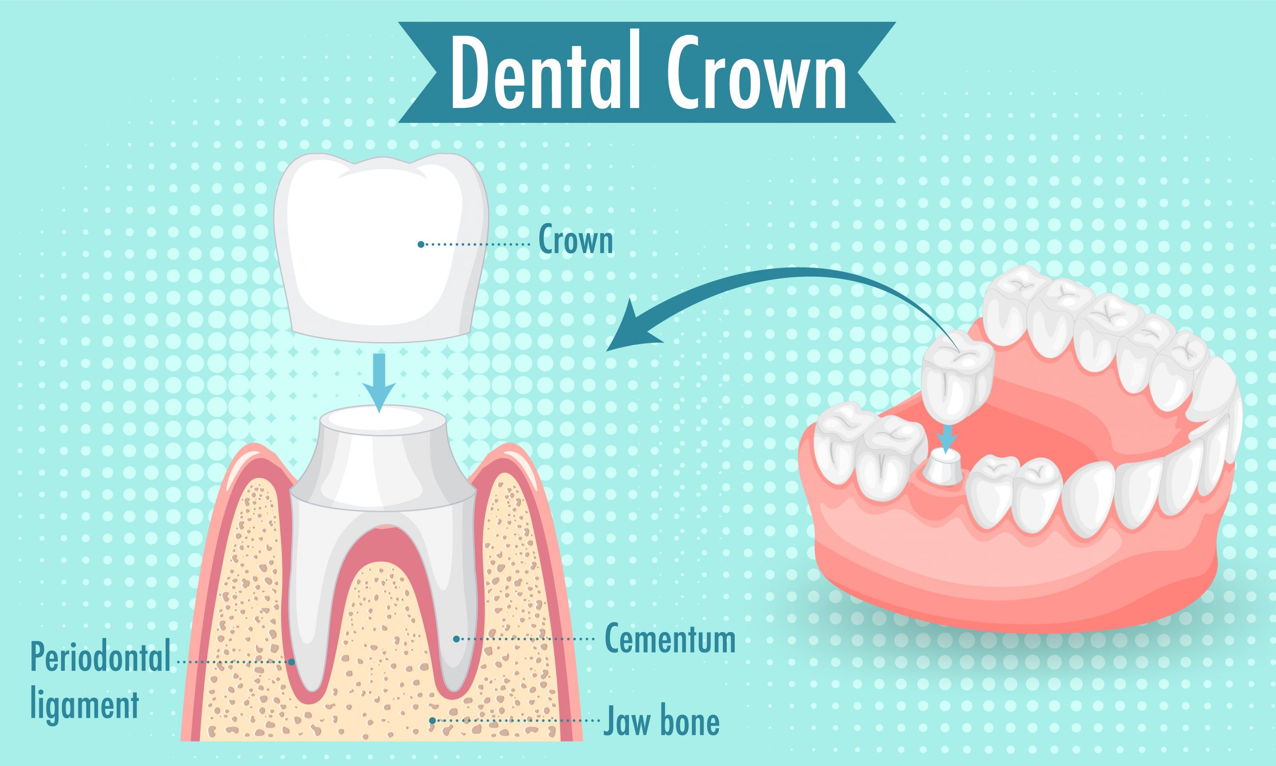 Dental Crown Types Procedure And Cost 